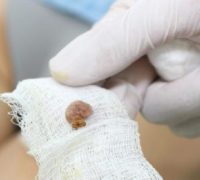 Хірургічне видалення папілом