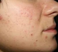 Лікування вугрової хвороби