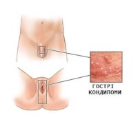 гострі кондиломи