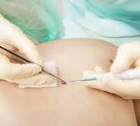 лазеротерапія і кріотерапія