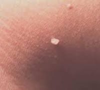 вірус папіломи людини