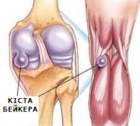 кіста Бейкера